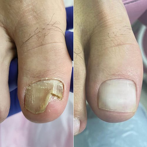 Depoimento de resultado após uso do ClearNail